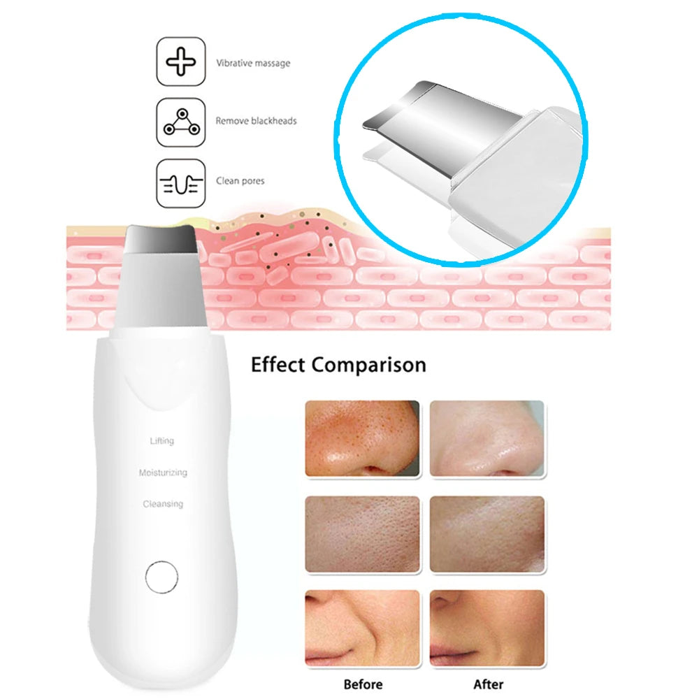 Facial Skin Scrubber – Vibrating Blackhead Remover & Face Lifting Spatula Tool